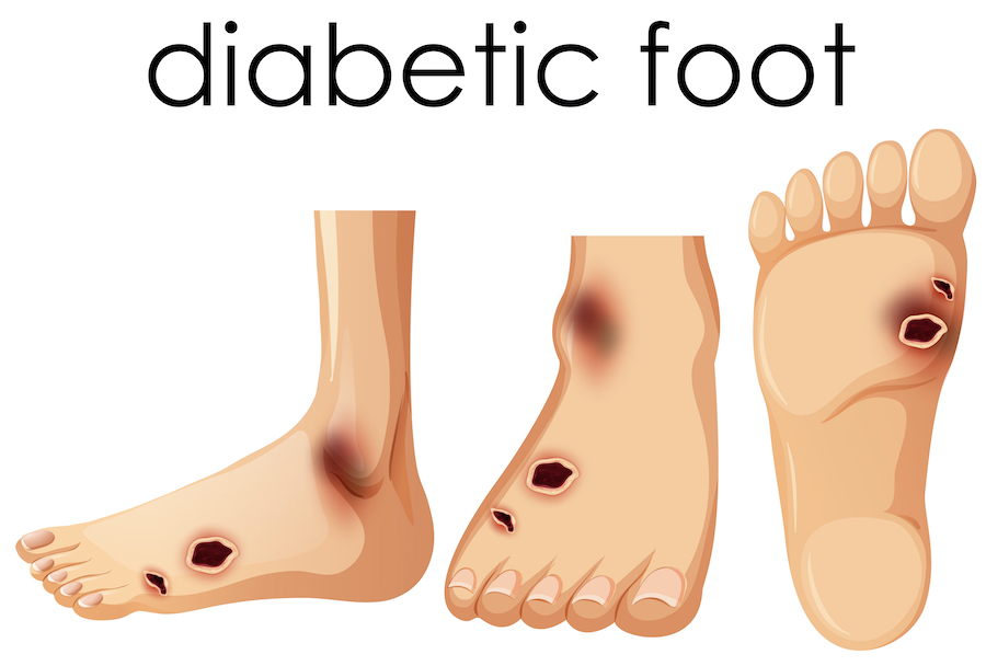 Diabetic Foot Care: Tips for Healthy Feet With Diabetes