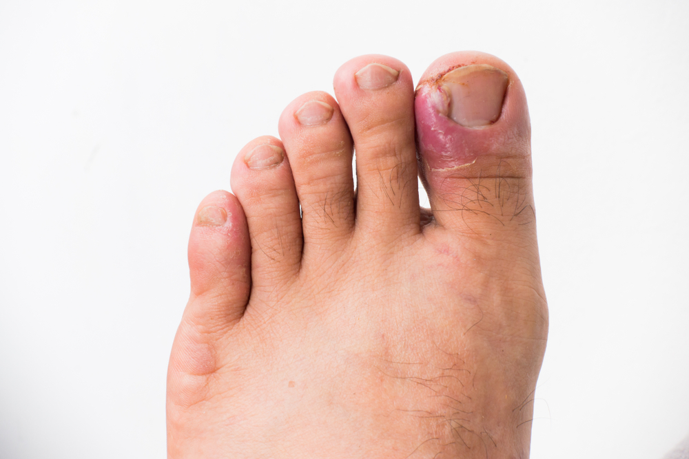 Does a Thick Toenail Mean a Fungal Infection? | Does a thick #toenail mean  it's time to seek treatment for a #toenailfungus? This video will explain  what this symptom could mean, and
