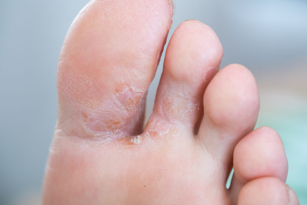 Top Tips for Athletes to Maintain Healthy Feet - Podiatry of Greater  Cleveland