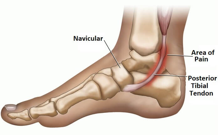 Posterior Tibial Tendonitis Podiatry Of Greater Cleveland 6873