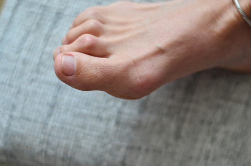 what is a hammertoe