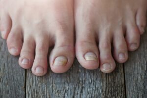 The Truth About Toenail Fungus: Myths and Facts - Podiatry of Greater